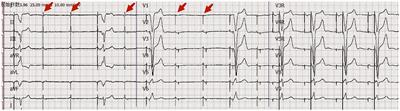 Case report: An elderly woman with recurrent syncope after pacemaker implantation
